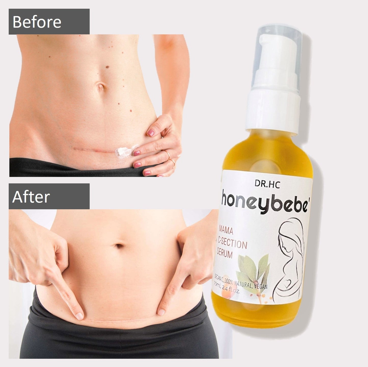 DR.HC Honeybebe' Mama C-Section Serum (100% Organic, Natural & Vegan) (70ml, 2.4 fl.oz.)